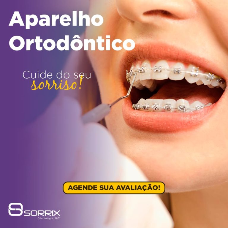 Alinhador Estético - Sorrile Ortodontia Sorocaba